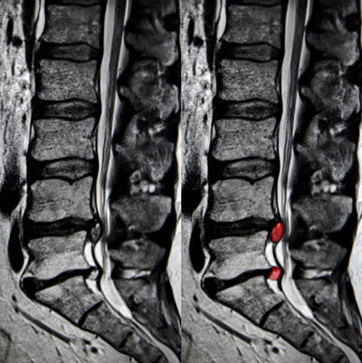 Sciatica