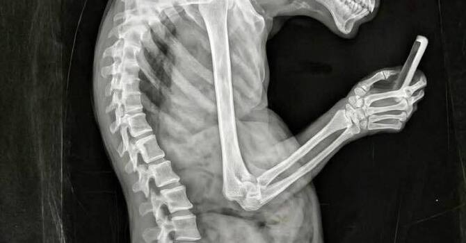 How Screen Time Affects Spinal Health | Tech Neck Care in Huntsville | Spine Align Chiropractic & Wellness image