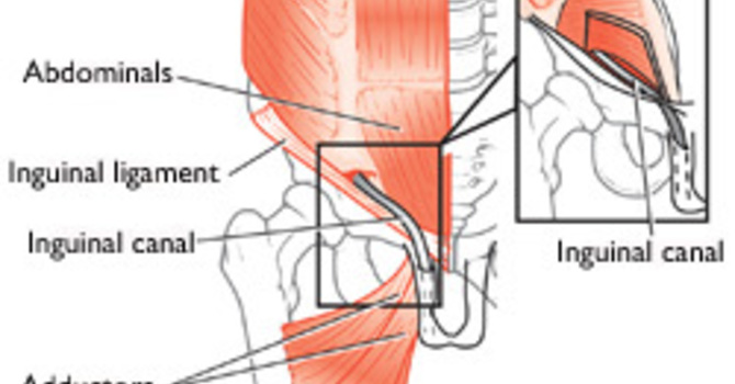 Osteoarthritis (Disc Disease)