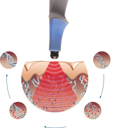 Link to: /pages/radiofrequency