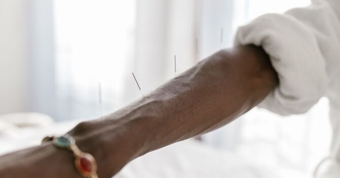 Acupuncture Injection Therapy: Vitamin B5 image