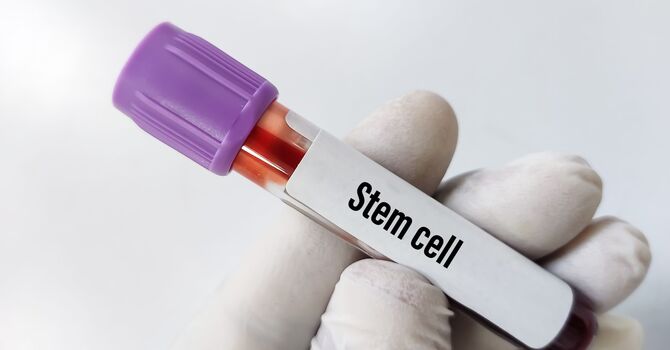 Autologous Stem Cells for Knee Osteoarthritis image
