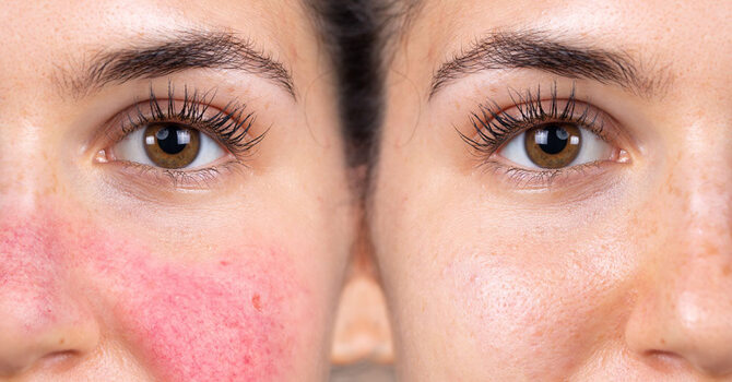 IPL (Intense Pulsed Light) Skin Rejuvenation