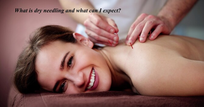 What Is Dry Needling and How Does It Help Relieve Muscle Pain? image