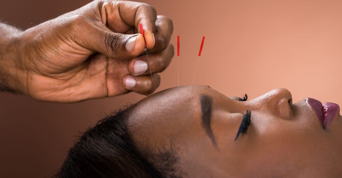 Acupuncture