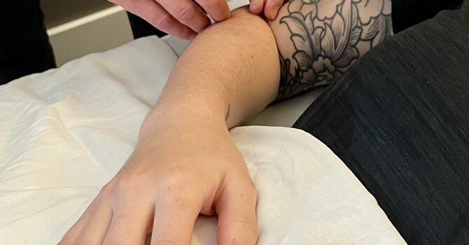 Acupuncture