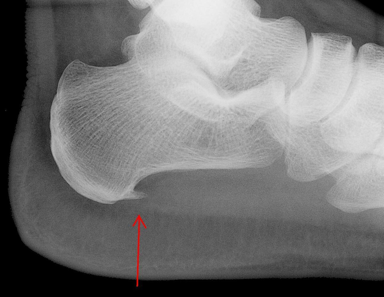 Lateral heel X-ray showing a plantar calcaneal spur near the underside of the heel bone.