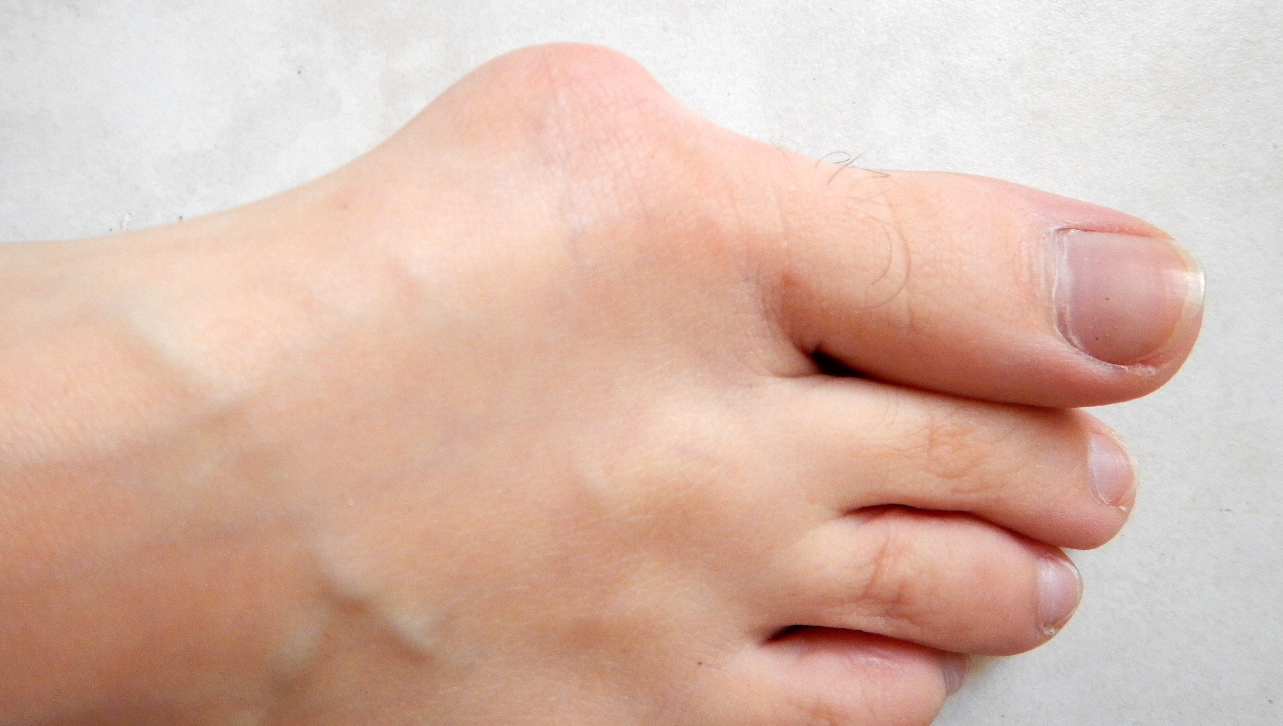 Hallux valgus changes the alignment of the big toe and first metatarsophalangeal joint.