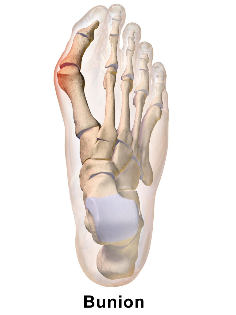 A bunion involves a change in the alignment of the big toe and the first metatarsal.