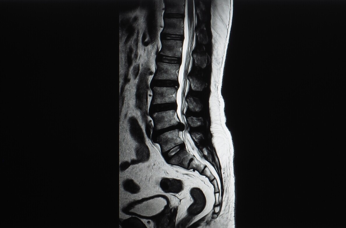 Sagittal view of a lumbar spine MRI scan showing intervertebral discs and vertebrae.