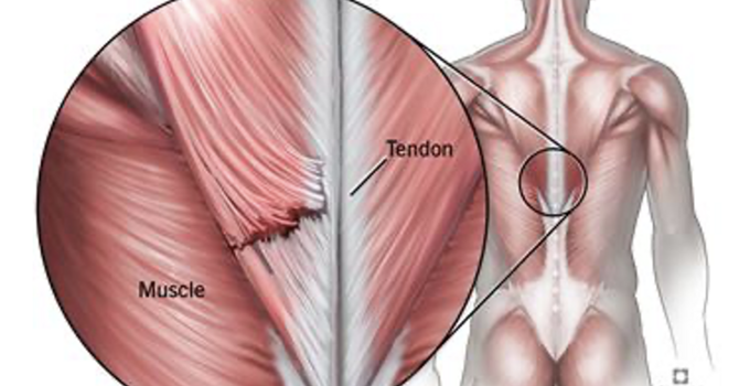 Muscle Strains