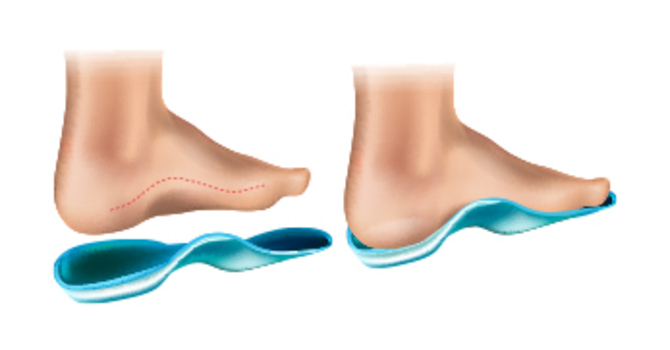 Custom-Made Orthotics