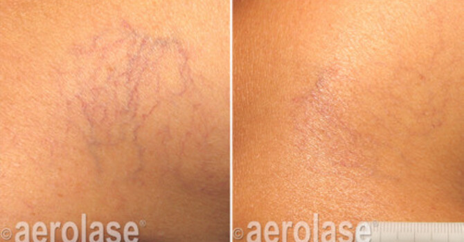 Aerolase Neo V