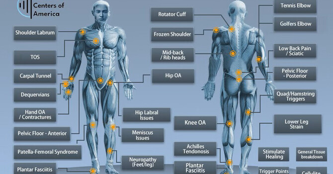 Types of Shockwave Therapy: What’s the Difference and Which Is Right for You? image