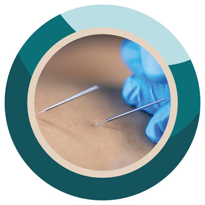 dry-needling