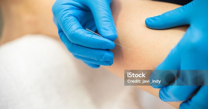 Dry Needling