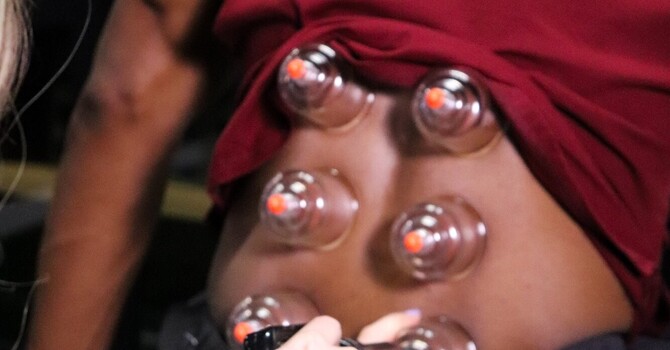 How Cupping Therapy Helps Athletes Recover Faster image
