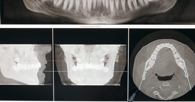 TMJ Dysfunction & the Cranial System: An Osteopathic Perspective image