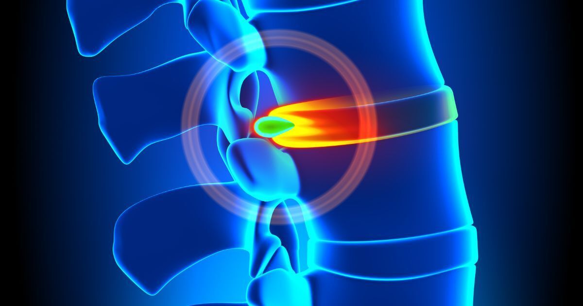 Cox Technique for Disc Pain