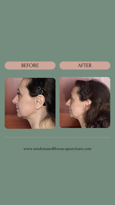 Cosmetic acupuncture in San Diego before and after facial contouring results in San Diego