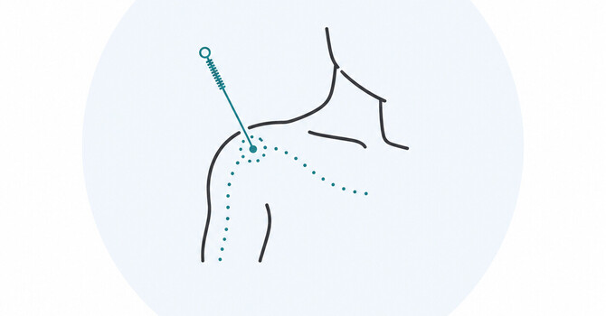 Acupuncture