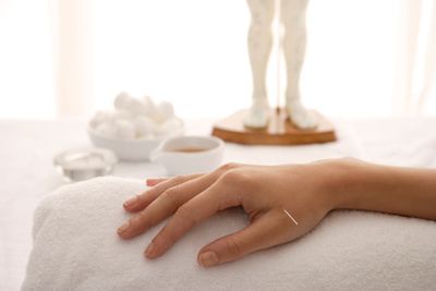 Patient with acupuncture needle getting treat for their mental health