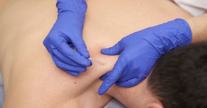 How Dry Needling Helps Athletes Recover from Overuse Injuries image