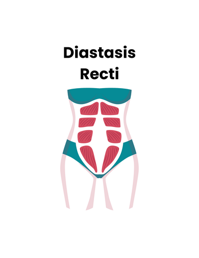 Learn more about diastasis recti