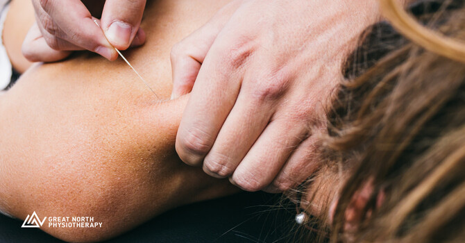 INTRAMUSCULAR STIMULATION (IMS) vs. ACUPUNCTURE image