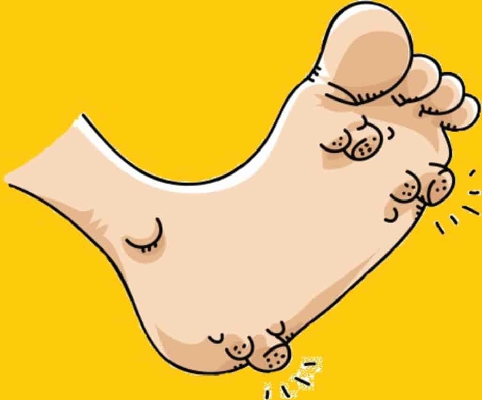 Plantar wart on the sole of a foot