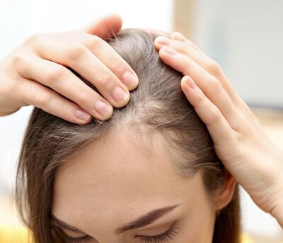 Hair Loss