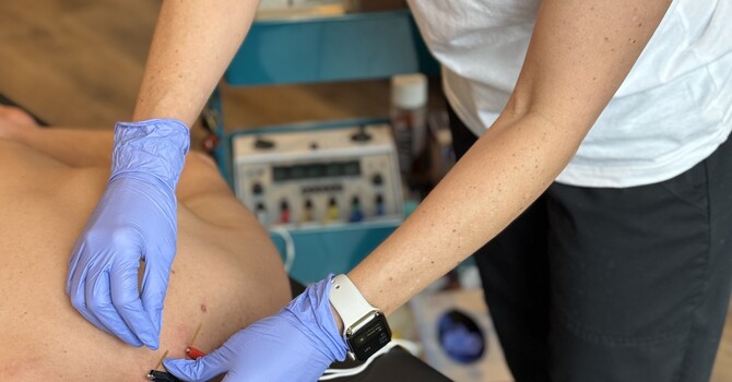 Dry Needling