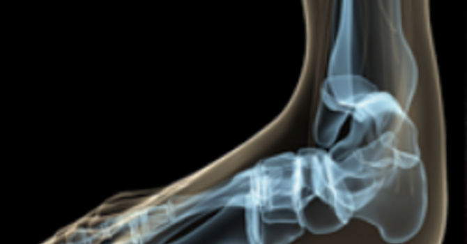 Plantar Fasciitis