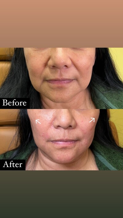 Upper Face (Cheek and Nasolabial Fold Filler)

