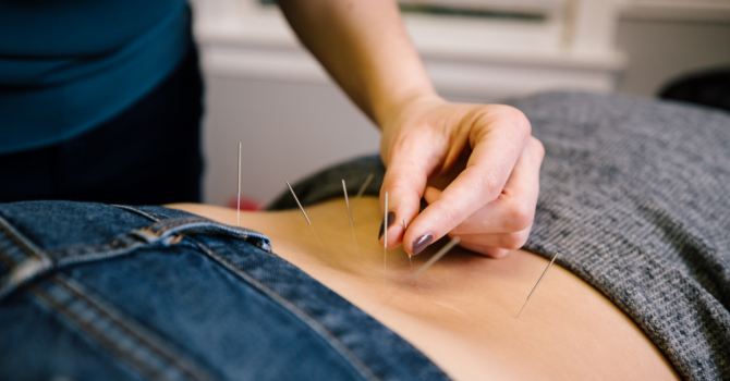 Dry Needling
