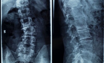 image of a spine on xray offered at green space health