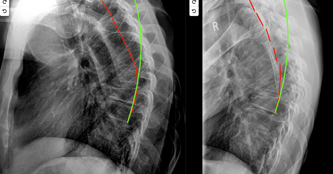 Kyphosis Treatment Charlotte NC — Scheuermann's Disease, Dowager's Hump, Thoracic Hyperkyphosis | Dr. Justin Dick | Clear Life Scoliosis