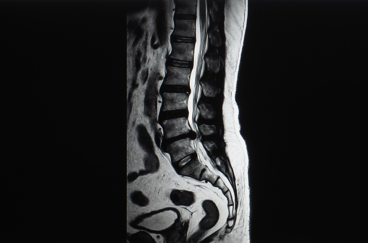 sagittal-lumbar-spine-mri-scan