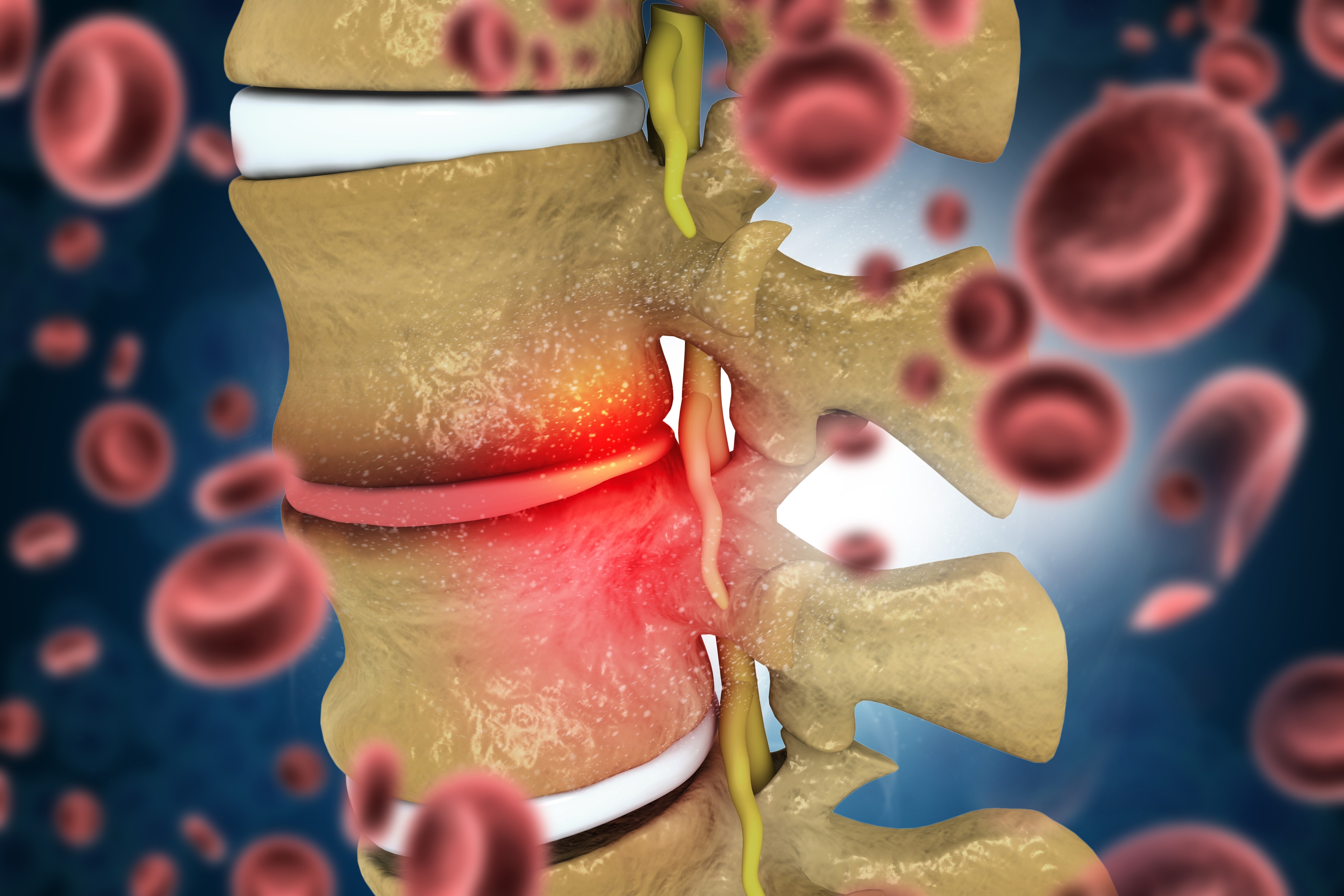 inflamed-lumbar-disc-nerve-root-compression
