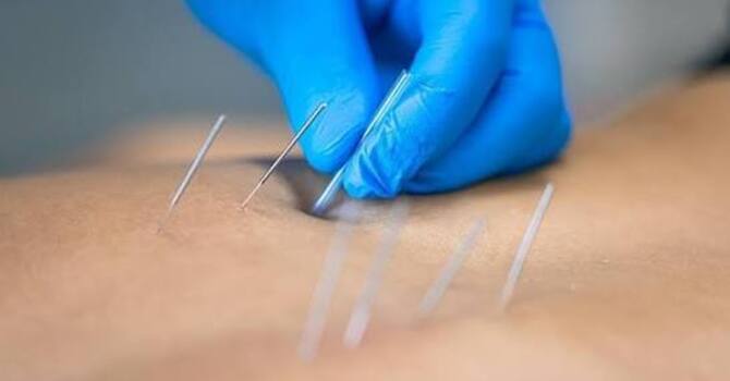 Dry Needling image