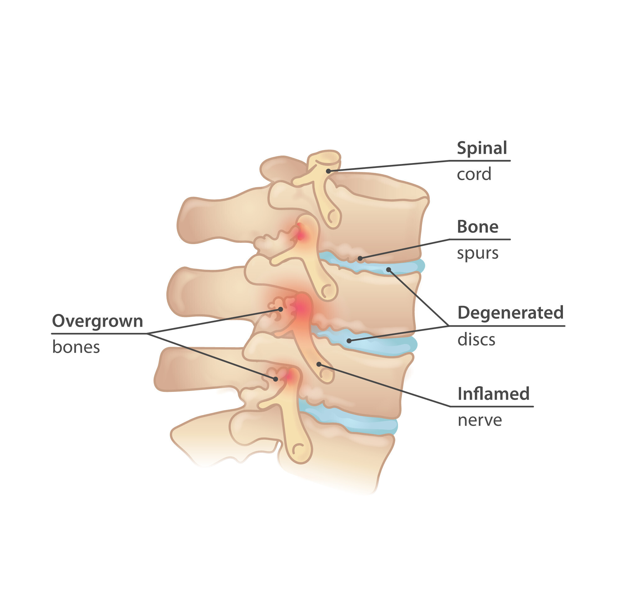 Spine_Bone_Sours_Degenerated_Disk_v1-02