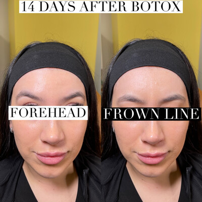 Frown line