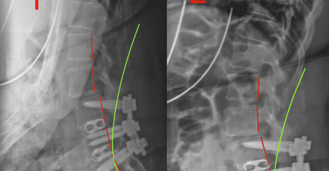 Refractory Lumbar Pain After Motor Vehicle Collision: A Case-Based Analysis of Multimodal Conservative Structural Rehabilitation image