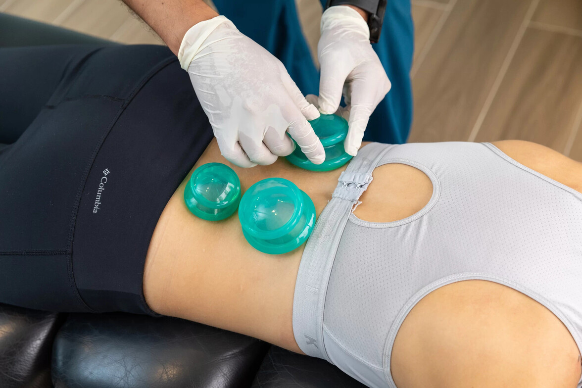 Cupping at Motion Pro Health in Coquitlam Square and Metrotown Burnaby