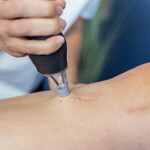 LymphaTouch® negative pressure therapy being used on a healed surgical scar.