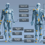 Shockwave therapy treatment areas showing common conditions including plantar fasciitis, knee pain, hip pain, shoulder injuries, and neuropathy