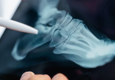 digital xray of a foot for neuropathy treatments