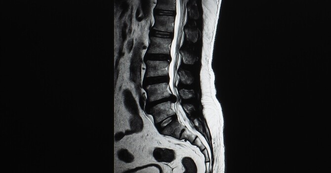 Herniated Disc, Bulging Disc, or Blown Disc? 