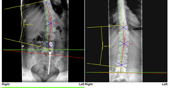 Adult Scoliosis, De Novo Scoliosis: A Documented Case of Non-Surgical Curve Reduction