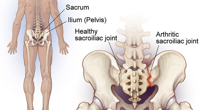 SI Joint Pain vs. Low Back Pain: How Are They Different? image